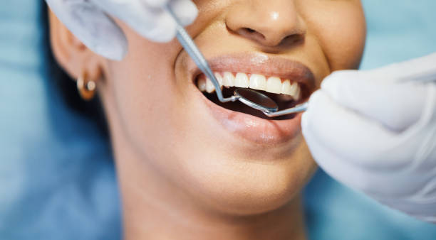 Best Chipped Tooth Repair Near Me  in Benson, UT